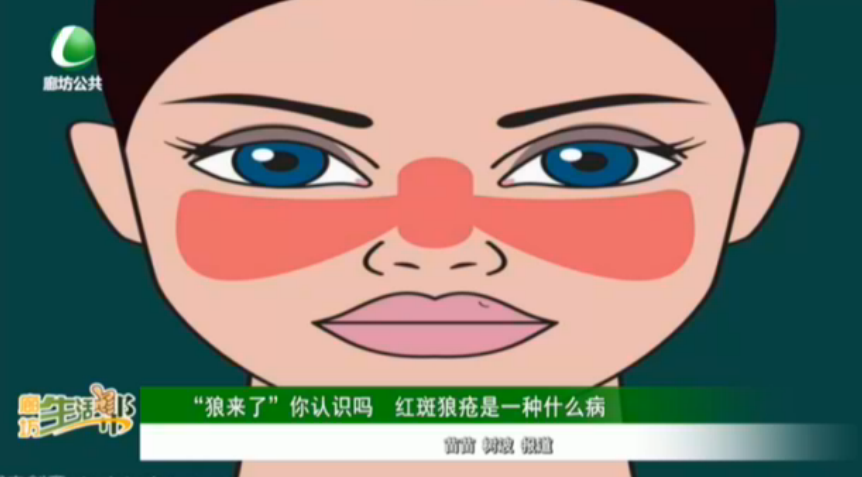 “狼來了”你認(rèn)識(shí)嗎 紅斑狼瘡是一種什么病